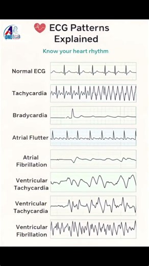 Normal vs Abnormal ECG Rhythms Explained Fast #cardiology #nursing #shorts #tips #medico #ecgtest