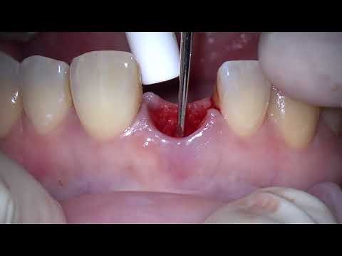 Immediate Implant with immediate crown