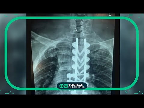 How botox is being used to treat a unique muscle spasm