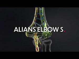Alians Elbow S range - Management of elbow fractures