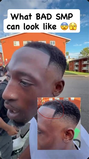 Understanding Scalp Micropigmentation: Transforming Baldness