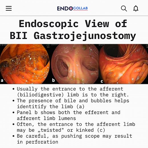 Endoscopic View of BII Gastrojejunostomy | EndoCollab