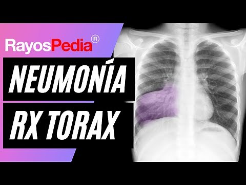 Neumonía y Broncograma aéreo en radiografía de tórax