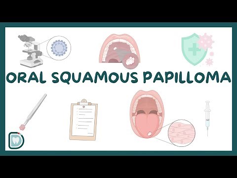 Oral Squamous Papilloma: Causes, Diagnosis, Types, and Management