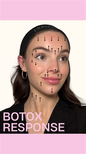 𝑲𝑬𝑵𝑵𝑬𝑫𝒀 𝑩𝑨𝑹𝑹𝑶𝑵 𝑩𝑺𝑵, 𝑹𝑵 I 𝔽𝕠𝕣𝕥 𝕎𝕠𝕣𝕥𝕙 𝔸𝕖𝕤𝕥𝕙𝕖𝕥𝕚𝕔 𝕀𝕟𝕛𝕖𝕔𝕥𝕠𝕣 on Instagram: "You're go to map of how the muscles in our face relax and respond to Botox 💉 #nurseinjector #injectables #nurse #beforeandafter #fortworthinjector #fortworthbotox #neurotoxin #dfw #dfwmedspa #explorerpage"