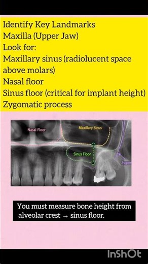 How to read OPG for implant planing #dentaleducation #dentist #implant
