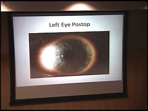 Laser Astigmatic Correction: Using Intralase With Phacoemulsification