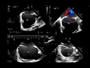 Is it cor triatriatum dexter or elongated Eustachian valve?