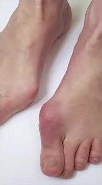 How to Check a Fracture & Keep It Safe Before Seeing a Doctor | Dr. Anurag Baderiya