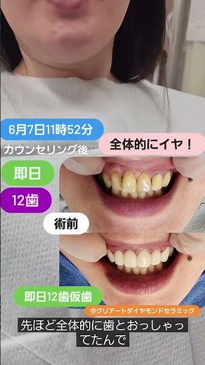 全体的にイヤ！というお悩みです。歯並び、差し歯、虫歯治療の後、新たにできた虫歯、金属土台、根っこの治療、根っこの再治療などをしつつ即日12歯仮歯まで進めていきました #セラミック
