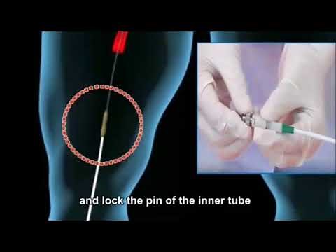 Percutaneous transluminal balloon pulmonary valvuloplasty (PBPV) AIIMS BHUBANESWAR.