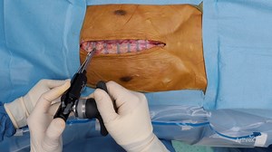 FiberTape® Sternal Closure Using Figure 8 and Dual-Tensioner Technique