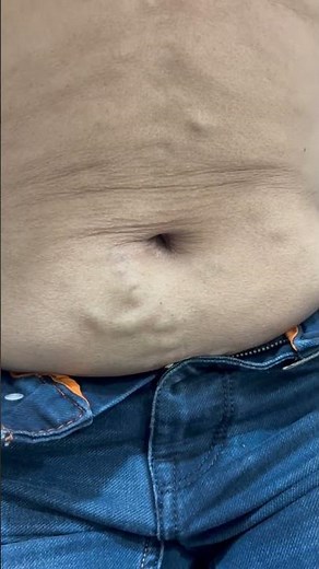 😱What Are These Abdominal Veins? Caput Medusae - sign of liver damage.