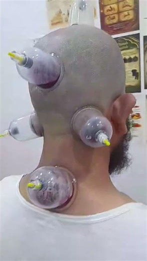 Head Hijamah - Part 1
