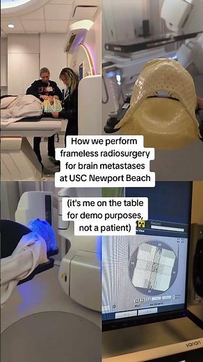 How we do focal brain radiation (stereotactic radiosurgery) at USC