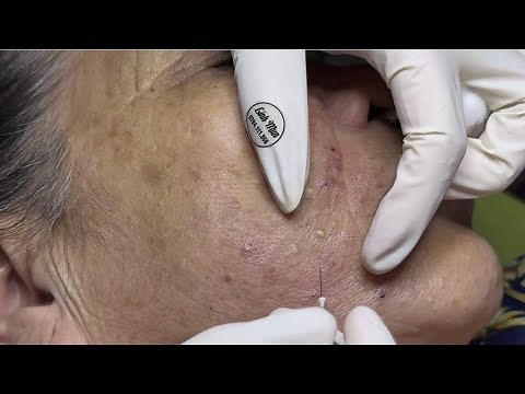 Steatocystoma-Like Extraction for Mature Skin (Part 2) | Long Sebum Filaments | Spa Linh Mun