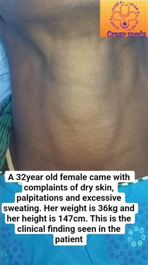 Clinical case scenario - 1 #clinical #medicine #treatment #thyroid #hyperthyroid #trending #shorts