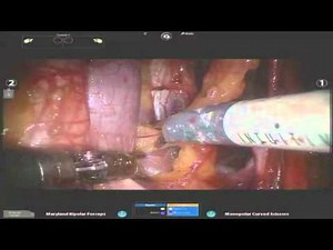 Extended Pelvic Nodes Excision - Robot Assistance • Video • MEDtube.net