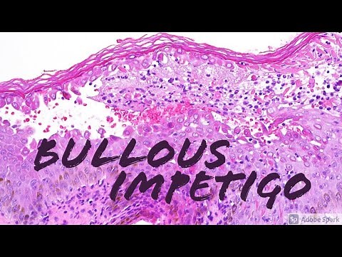 Bullous Impetigo vs Staphylococcal Scalded Skin (SSSS): 5-Minute Pathology Pearls