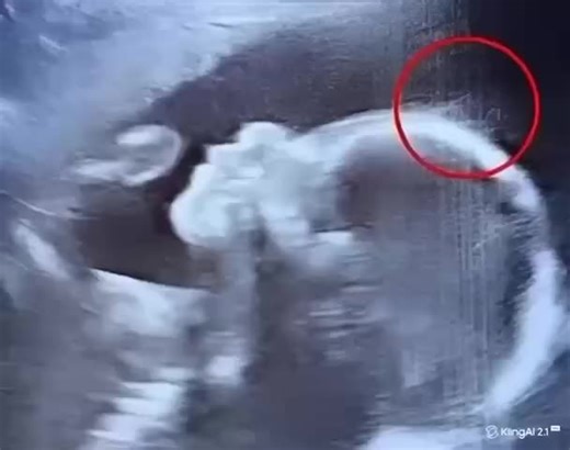 What Doctors Spotted on the Ultrasound Left Them Speechless — And This Baby Girl Captivated Everyone from the Moment She Was Born 👶🩷✨ When 29-year-old Emily Foster from Kent, England 🇬🇧, walked into the hospital for her 20-week pregnancy sc | InspireDaily