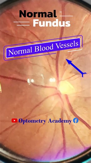 Normal fundus | Normal Retina | Smartphone Fundus Videography | Fundus Photography | Short Video 454