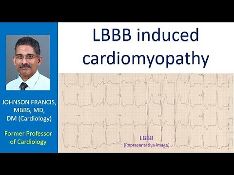 LBBB induced cardiomyopathy