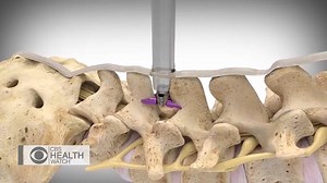 Suffering from back pain due to Lumbar Spinal Stenosis? Florida Spine Specialists offers a small procedure that can get you back to normal. #backpainrelief #sponsored | CBS Miami | Facebook