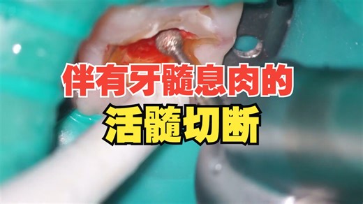 伴有牙髓息肉的活髓切断 pulp polyp pulpotomy