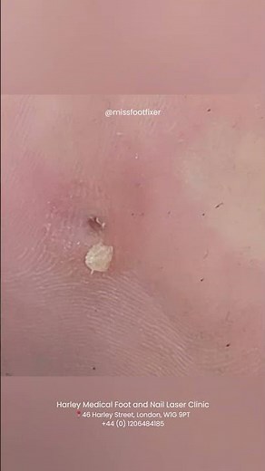 Tiny Corn, HUGE Pain! by Miss Foot Fixer Marion Yau
