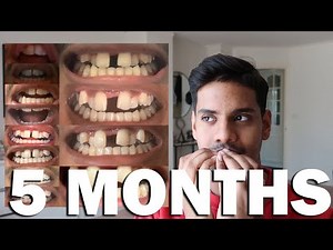 5-Months Post-Op Jaw Expansion Surgery (SARPE) - Brace yourself!