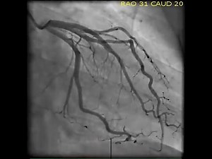 Coronary Angiography _ NEJM