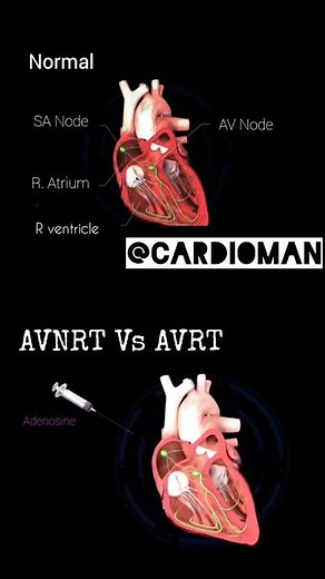 AVNRT Vs AVRT 🫀 quick ECG & management. #cardiology #ecginterpretation
