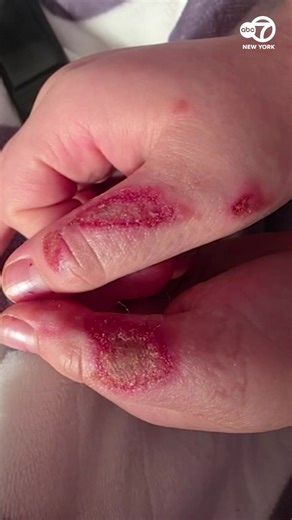 36K views · 285 reactions | A 9-year-old is urging other children to not follow "Needoh Cube Microwave Trend" after suffering severe burns. https://abc7ny.com/post/tiktok-trend-needoh-cube-boy-burned-social-media-loyola-medicine-shares-urgent-warning/18541139/ | ABC7NY | Facebook