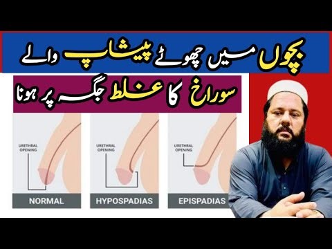 Hypospadias & Epispadias symptoms and treatment | #hypospadias #epispadias #symtoms #treatment