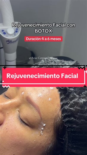 ¿Arruguitas, líneas de expresión o mirada cansada? La Toxina Botulínica Full Face es la solución ✨ Natural, segura y con resultados visibles. 💉 Agenda tu cita hoy y luce un rostro más joven y descansado. #viral #botox #lima #foryou #fyp