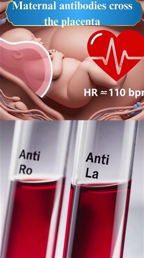 Congenital Heart Block & Anti-Ro Antibodies (High Yield OBGYN)