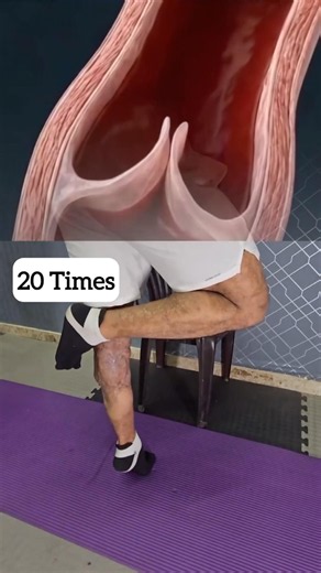 Varicose veins in legs, don’t skip these exercises. These may help you.