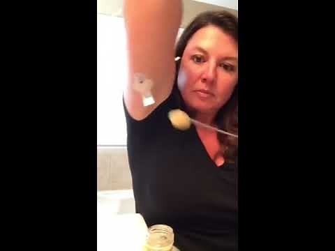 Inserting Medtronic Guardian or Enlite Sensor in arm by self