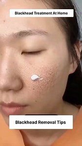 215K views · 1.4K reactions | Easy Hack To Remove Blackheads & Open Pores | Get Clear Glowing Skin #blackheads #whiteheads #hack #openpores #facebookviral #reelsviralシ | Health Beauty Treat | Facebook