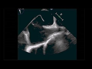 Transesophageal Echocardiogram Detecting a High-Risk Patent Foramen Ovale
