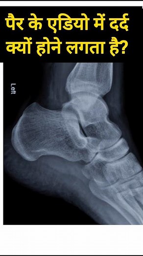Calcaneum Spur Cause Heel Pain