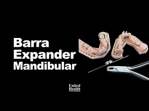 Barra Expander Mandibular