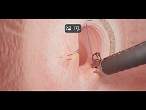 Transoral Outlet Reduction (TORe) Animation