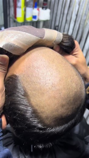 Best Hair Patch for Hair Replacement Solutions