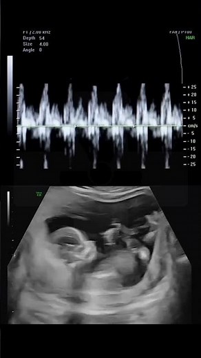This is What a Baby's Heartbeat Sounds Like During an Ultrasound #science #natal #shorts