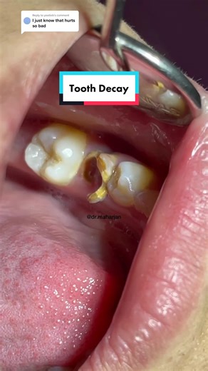 Understanding Tooth Decay: Causes, Symptoms, and Treatments