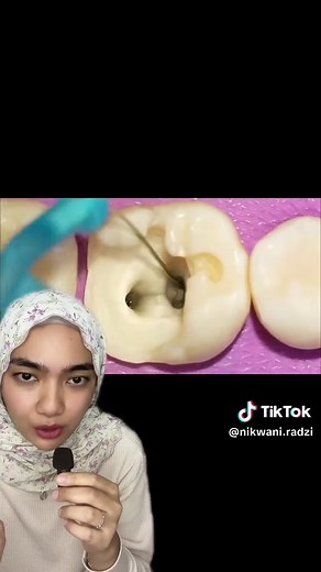 Root canal, fiber post and crown procedures! Credit video to @Dr.Mahmoud adel🦷 #dentistsoftiktok #dentistexplains #dentaleducation #rootcanaltreatment #dentalcrown #dentalpost #caries