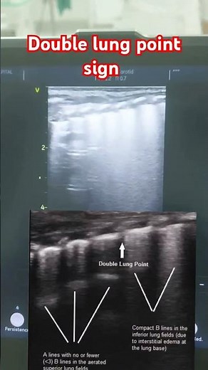 Neonatal Lung Ultrasound | showing Double Lung point sign in neonate with TTN #neonates #pocus #baby