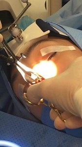 Deviated Septum Repair Technique with Minimal Packing (GRAPHIC)