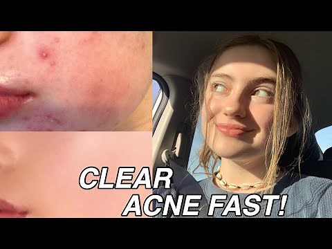 HOW TO REALLY CLEAR ACNE FAST !! // skincare routine